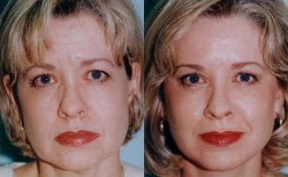 Facelift before and after photo by Kristin J. Tarbet, M.D. in Bellevue, WA