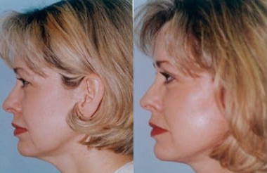 Facelift before and after photo by Kristin J. Tarbet, M.D. in Bellevue, WA