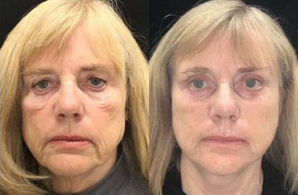 Facelift before and after photo by Kristin J. Tarbet, M.D. in Bellevue, WA