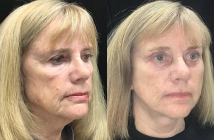 Facelift before and after photo by Kristin J. Tarbet, M.D. in Bellevue, WA