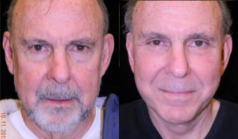 Facelift before and after photo by Kristin J. Tarbet, M.D. in Bellevue, WA