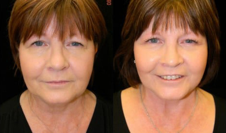 Facelift before and after photo by Kristin J. Tarbet, M.D. in Bellevue, WA