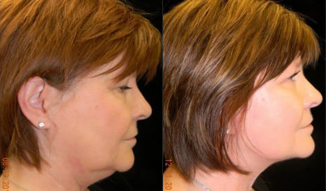 Facelift before and after photo by Kristin J. Tarbet, M.D. in Bellevue, WA
