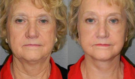 Facelift before and after photo by Kristin J. Tarbet, M.D. in Bellevue, WA
