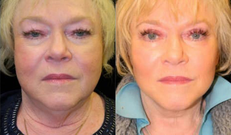 Facelift before and after photo by Kristin J. Tarbet, M.D. in Bellevue, WA