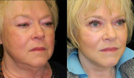 Facelift before and after photo by Kristin J. Tarbet, M.D. in Bellevue, WA