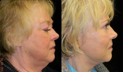 Facelift before and after photo by Kristin J. Tarbet, M.D. in Bellevue, WA