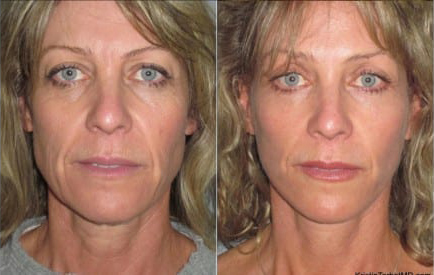 Facelift before and after photo by Kristin J. Tarbet, M.D. in Bellevue, WA