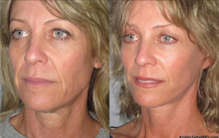 Facelift before and after photo by Kristin J. Tarbet, M.D. in Bellevue, WA