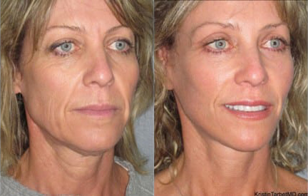 Facelift before and after photo by Kristin J. Tarbet, M.D. in Bellevue, WA