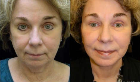 Facelift before and after photo by Kristin J. Tarbet, M.D. in Bellevue, WA