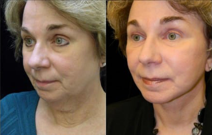 Facelift before and after photo by Kristin J. Tarbet, M.D. in Bellevue, WA