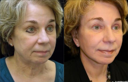 Facelift before and after photo by Kristin J. Tarbet, M.D. in Bellevue, WA