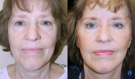 Facelift before and after photo by Kristin J. Tarbet, M.D. in Bellevue, WA