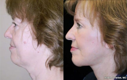 Facelift before and after photo by Kristin J. Tarbet, M.D. in Bellevue, WA
