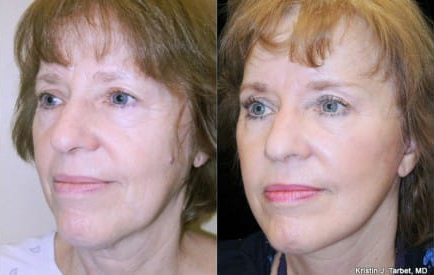Facelift before and after photo by Kristin J. Tarbet, M.D. in Bellevue, WA