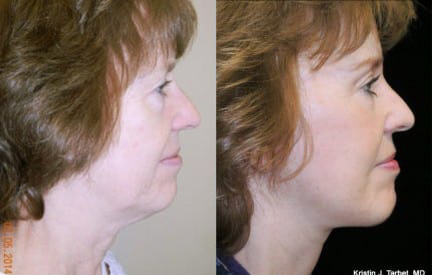 Facelift before and after photo by Kristin J. Tarbet, M.D. in Bellevue, WA