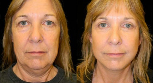 Facelift before and after photo by Kristin J. Tarbet, M.D. in Bellevue, WA