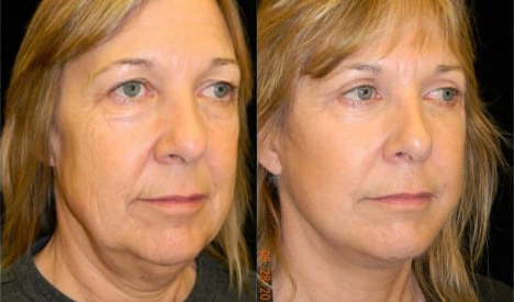 Facelift before and after photo by Kristin J. Tarbet, M.D. in Bellevue, WA