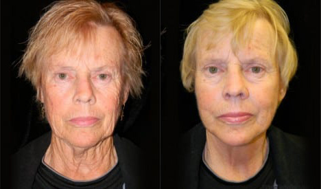 Facelift before and after photo by Kristin J. Tarbet, M.D. in Bellevue, WA