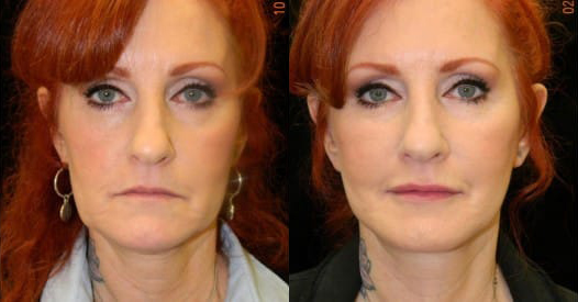 Facelift before and after photo by Kristin J. Tarbet, M.D. in Bellevue, WA