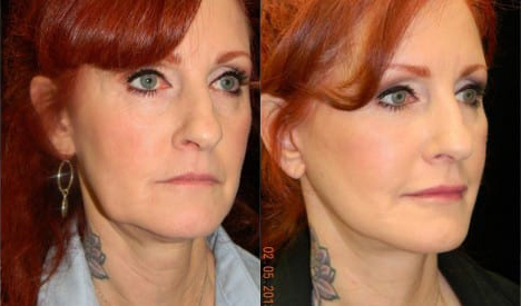 Facelift before and after photo by Kristin J. Tarbet, M.D. in Bellevue, WA