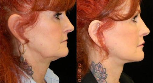 Facelift before and after photo by Kristin J. Tarbet, M.D. in Bellevue, WA