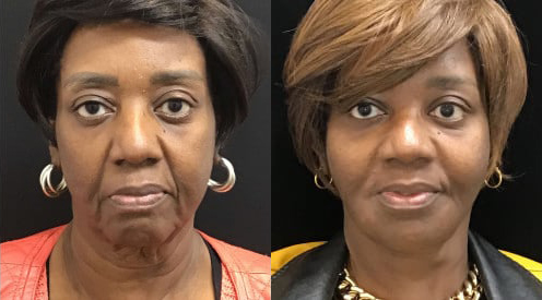 Facelift before and after photo by Kristin J. Tarbet, M.D. in Bellevue, WA