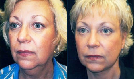 Facelift before and after photo by Kristin J. Tarbet, M.D. in Bellevue, WA