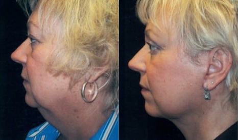 Facelift before and after photo by Kristin J. Tarbet, M.D. in Bellevue, WA