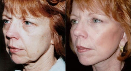 Facelift before and after photo by Kristin J. Tarbet, M.D. in Bellevue, WA
