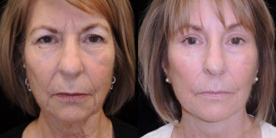 Facelift before and after photo by Kristin J. Tarbet, M.D. in Bellevue, WA