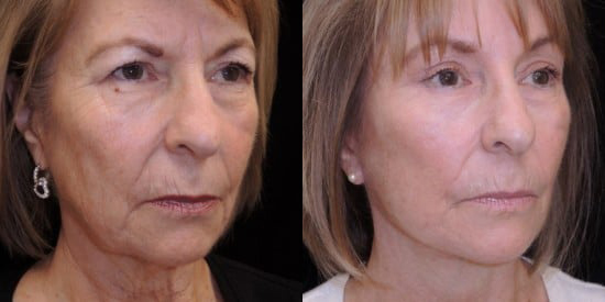 Facelift before and after photo by Kristin J. Tarbet, M.D. in Bellevue, WA