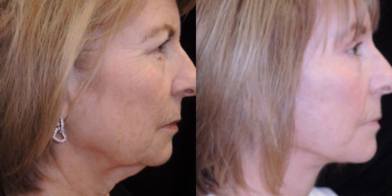Facelift before and after photo by Kristin J. Tarbet, M.D. in Bellevue, WA