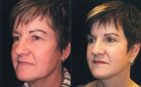 Facelift before and after photo by Kristin J. Tarbet, M.D. in Bellevue, WA