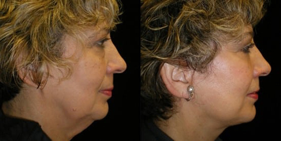 Facelift before and after photo by Kristin J. Tarbet, M.D. in Bellevue, WA