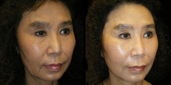 Facelift before and after photo by Kristin J. Tarbet, M.D. in Bellevue, WA