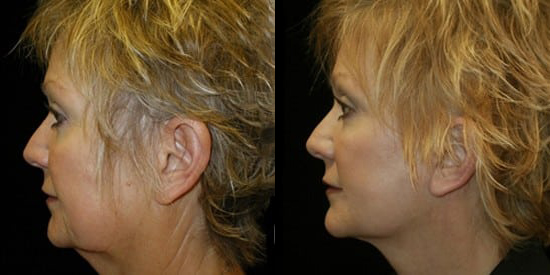 Facelift before and after photo by Kristin J. Tarbet, M.D. in Bellevue, WA