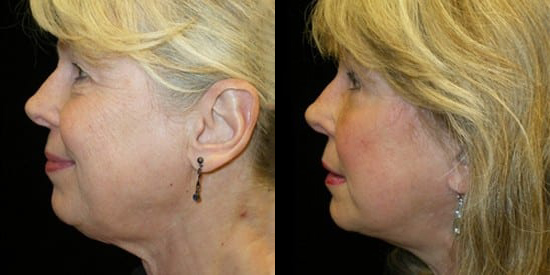 Facelift before and after photo by Kristin J. Tarbet, M.D. in Bellevue, WA