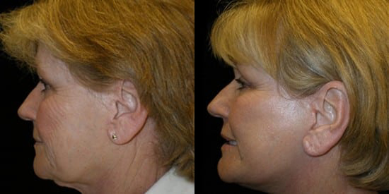 Facelift before and after photo by Kristin J. Tarbet, M.D. in Bellevue, WA