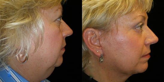 Facelift before and after photo by Kristin J. Tarbet, M.D. in Bellevue, WA