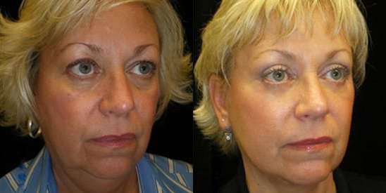 Facelift before and after photo by Kristin J. Tarbet, M.D. in Bellevue, WA