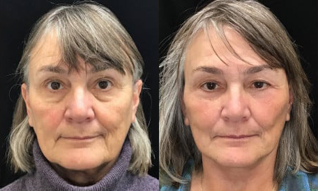 Facelift before and after photo by Kristin J. Tarbet, M.D. in Bellevue, WA