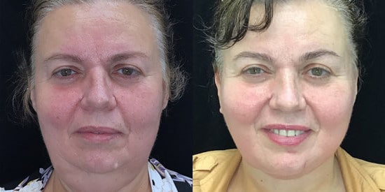 Facelift before and after photo by Kristin J. Tarbet, M.D. in Bellevue, WA