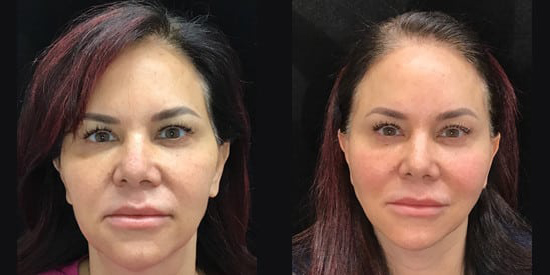Facelift before and after photo by Kristin J. Tarbet, M.D. in Bellevue, WA