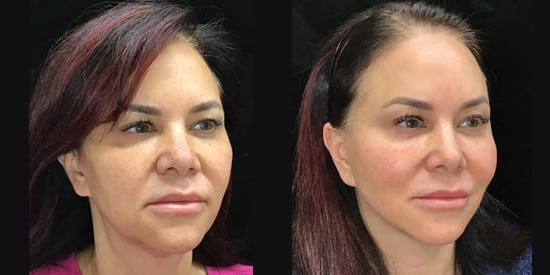 Facelift before and after photo by Kristin J. Tarbet, M.D. in Bellevue, WA