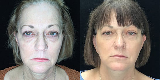Facelift before and after photo by Kristin J. Tarbet, M.D. in Bellevue, WA
