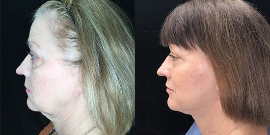 Facelift before and after photo by Kristin J. Tarbet, M.D. in Bellevue, WA