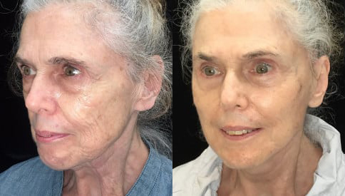 Facelift before and after photo by Kristin J. Tarbet, M.D. in Bellevue, WA