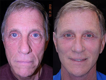 Facelift before and after photo by Kristin J. Tarbet, M.D. in Bellevue, WA